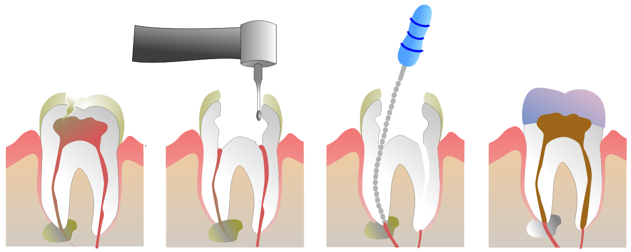 1280px-Root_Canal_Illustration_Molar.svg