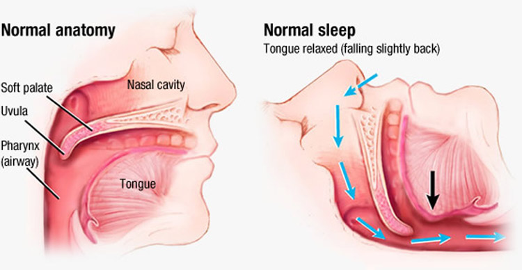 Surgery-For-Snoring-Treatments-For-Severe-Snoring-And-Sleep-Apnea