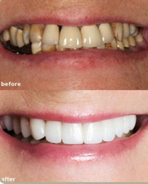 dentures_before_and_after_-31